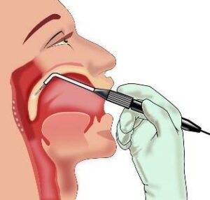 Riduzione volumetrica del palato molle mediante radiofrequenze.